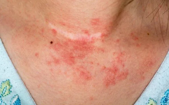 Dermatite de contato