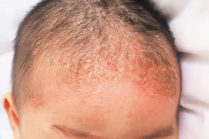 Dermatite seborreica