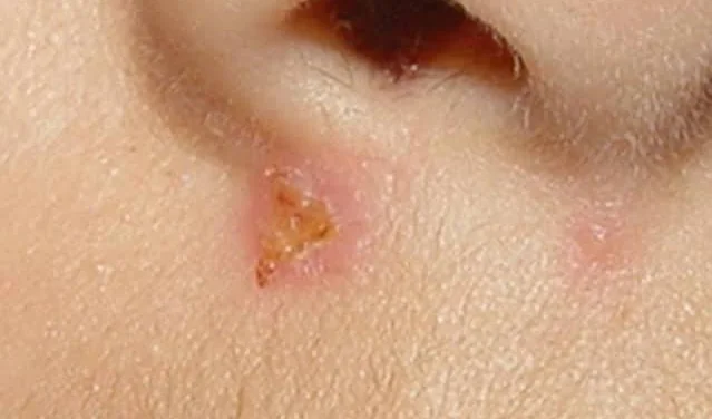Impetigo
