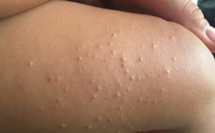 Molusco contagioso